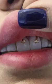 کاشت ژل تیپس 310،پرسینگ 100