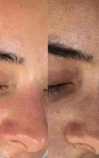 اصلاح تخصصی درماپلینگ، پاکسازی فیشیال