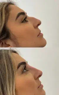 فول فیس ژل لب،گونه،چانه بوتاکس زاویه prp بینی