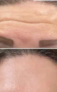 تمام خدمات ژل بوتاکس مزو جوانسازی.