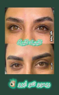 ریموو تتو ابرو و بدن(گلبرگ)