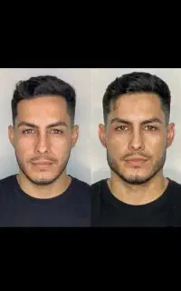 خدمات فیلر و بوتاکس ، مزو تراپی پوست و مو