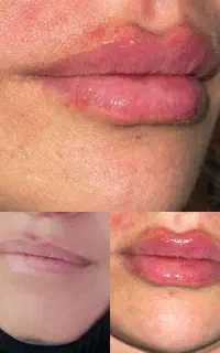 تزریغ ژل و بوتاکس