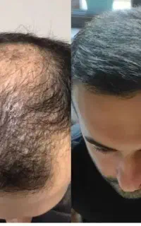 نوبت توعه به موهات اهمیت بدی