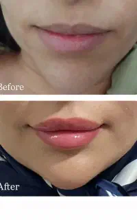فیلرگونه چانه لب خط خنده زاویه بوتاکس مزوژل