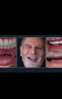 مرکز تخصصی ایمپلنت با اقساط ویژه