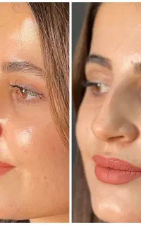 شرایط ویژه جراحی بینی