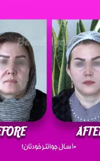 عمل زیبایی/عمل مکس لیفت/بلفارو/عمل بینی/لیفت صورت