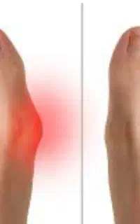 مرکز ارتوپدی درمان هالوکس والگوس (شصت پای کج)