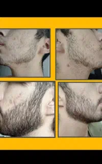 محلول رویش ریش و مو