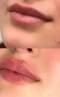 مدل برای ژل و بوتاکس