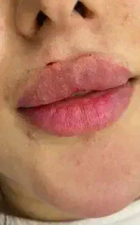 مدل تزریق ژل بوتاکس انزیم اصلاح فرم بینی