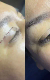 جشنواره تزریق چربی جراحی پلک ساکشن غبغب