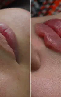 تزریق ژل بوتاکس فیلر لیزرمزو فشیال مطب زیبای برزگر