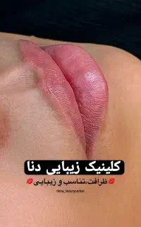 (کلینیک دنا)ژل بوتاکس لیزر نخ روشنی‌زیربغل وبیکینی