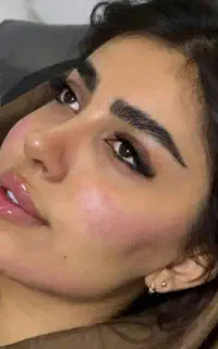 لیزر بوتاکس با قیمت قبل ژل اقتصادی مزو