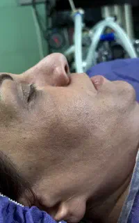 ساکشن شکم تزریق باسن آفر ویژه