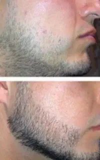 ریشت کم‌پشته شاید مشکل جای دیگست