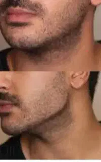 بوتاکس فیلر زیبایی