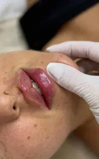 اولین مرکزبامتد(ام تکنیک) ژل بوتاکس فیلر آنزیم