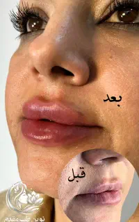 جشنواره تزریق ژل توسط پزشک با بیمه