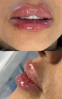 ژل،فیلر،بوتاکس،فشیال
