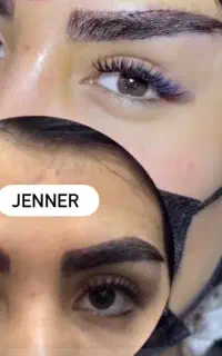 لیفت ابرو دایرکت ابرو توسط جراح
