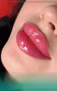 آموزش ژل و بوتاکس و آنزیم و مزوژل