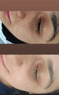 بازسازی پوست با سلولهای بنیادی