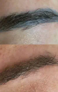 تخفیف ویژه پاک کردن تاتو آرایش داعم وتاتو بدن