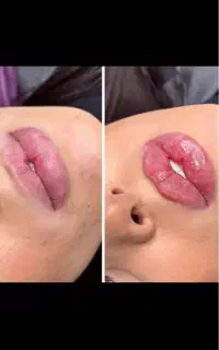 آفر ژل و بوتاکس