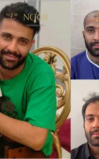 کاشت مو یک مرحله ای