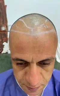 کاشت مو اقساطی/میکروگرافت