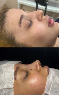 عمل بینی ساکشن غبغب ژل بوتاکس