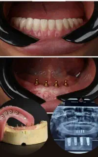 دنچر دیجیتالی اّوردنچر دندان مصنوعی ضمانتی