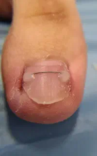 خدمات پودولوژی و درمان ناخن تو گوشتی