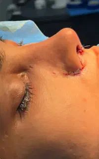 آف جراحی بینی