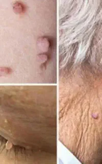 رفع ریشه ای زگیل تناسلی HPV