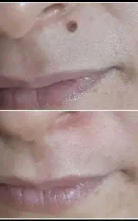 برداشت خال و منگوله صورت و گردن و دست