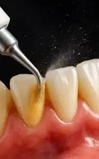 جرمگیری و پالیش دندان 5ت vipدرمنزل شمازیباجوی عزیز