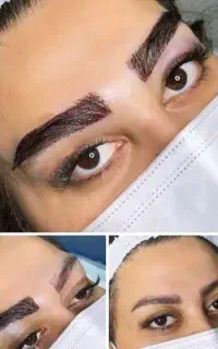 کاشت ابرو فقط ۱۰ میلیون بلفاروپلاستی آموزش کاشت