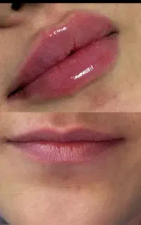 تزریقات ژل فیلر بوتاکs