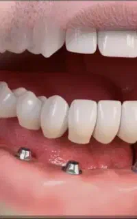 کاشت دندان ایمپلنت