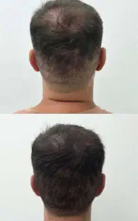 پرپشتی مو در سه جلسه با میکرواسکالپ
