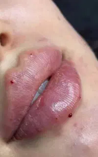 تخفیف 40درصد پی ار پی ژل بوتاکس فیلر