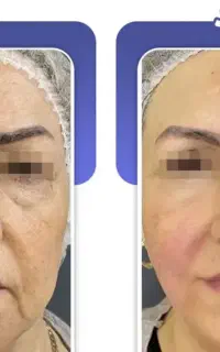 جشنواره هایفوتراپی جوانسازی و لیفت صورت و بدن