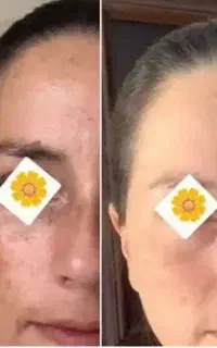 پوست صاف و شیشه ای ساختنیه