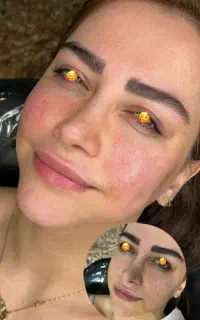 تزریق ژل‌وبوتاکس برای خانم هاوآقایان بسیارویژه