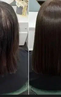 بزرگترین ایراد افراد دچار ریزش مو