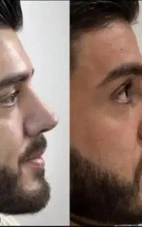عمل زیبایی بینی فقط با ۳۱میلیون تومان